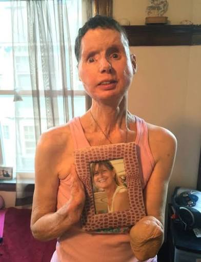 Travis the Chimpanzee Was Sandra Herold's World. On February 16, 2009, He Destroyed Her Best Friend. 4 Charla Nash holds a photograph of herself taken before the February 2009 chimpanzee attack that left her blind and permanently disfigured.