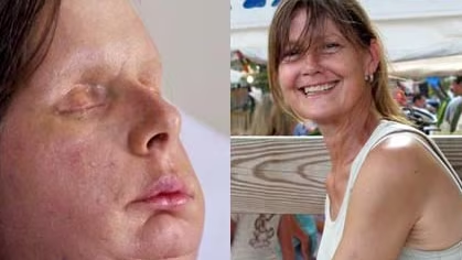 Travis the Chimpanzee Was Sandra Herold's World. On February 16, 2009, He Destroyed Her Best Friend. 5 Charla Nash underwent the nation's first full face transplant at the Cleveland Clinic in 2011, years after the attack left her blind and without hands. She later settled a lawsuit against Sandra Herold's estate for $4 million.