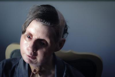 Travis the Chimpanzee Was Sandra Herold's World. On February 16, 2009, He Destroyed Her Best Friend. 6 Charla Nash, photographed after her face transplant surgery. Investigators found Xanax in Travis's system on the day of the attack, which may have contributed to his sudden aggression.